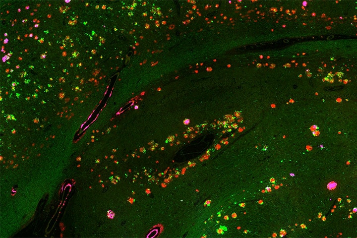 Maladie d’Alzheimer: perturbations synaptiques autour des plaques amyloïdes